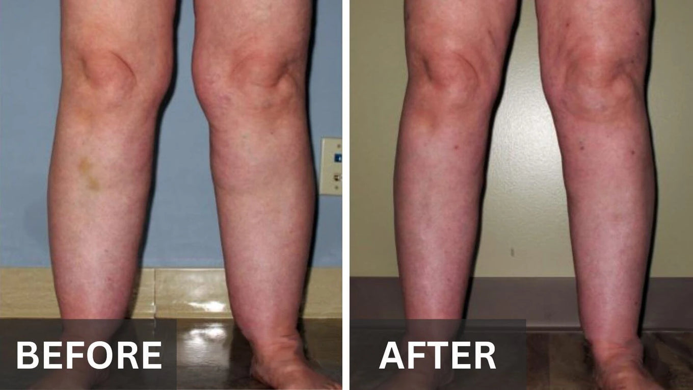 Why compression stockings may not be the answer for leg swelling