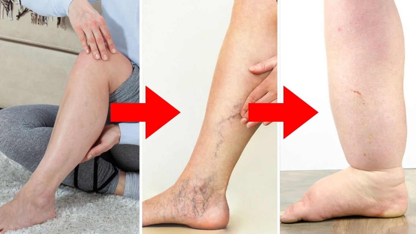 Why compression stockings may not be the answer for leg swelling