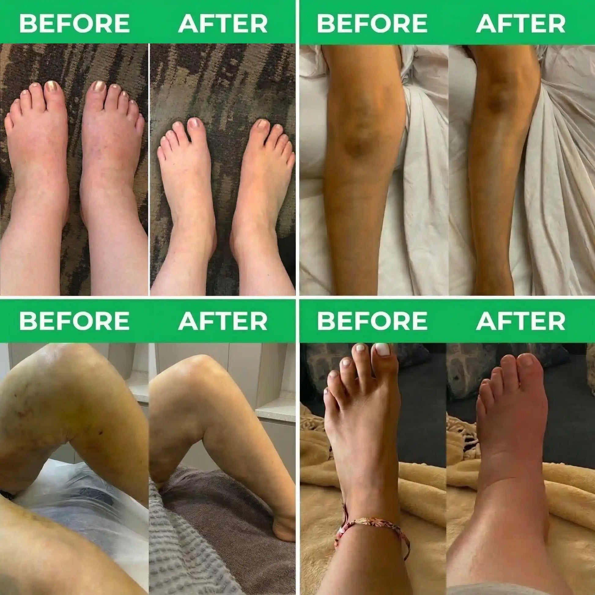 4 different Before and after results showing reduced leg swelling after 2 weeks of use